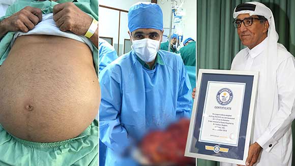 4.25 kg kidney removed from patient in Dubai confirmed as largest ever