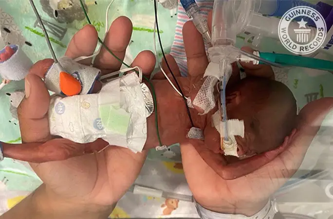 World's most premature baby defies sub-1% survival odds to break