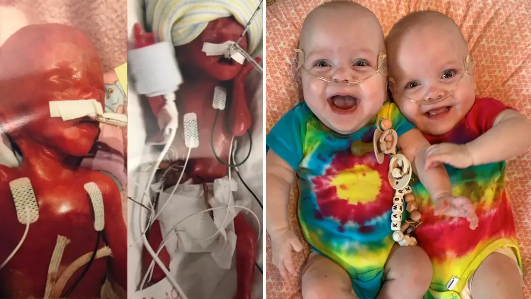 How the world’s most premature twins have defied the odds to celebrate their first birthday