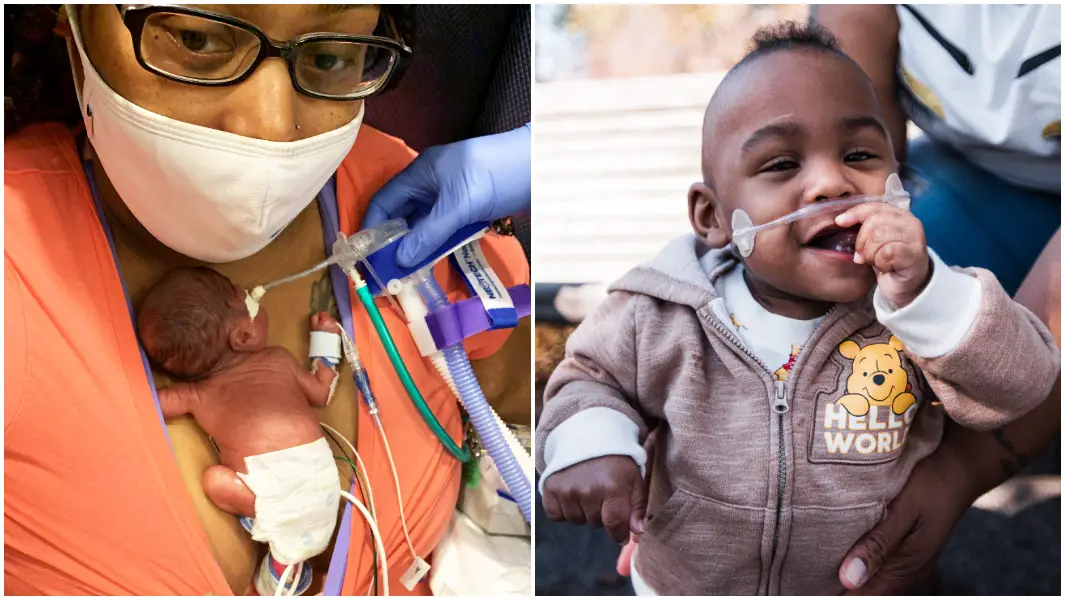 Nano preemie who weighed less than 1 pound now 6 years old