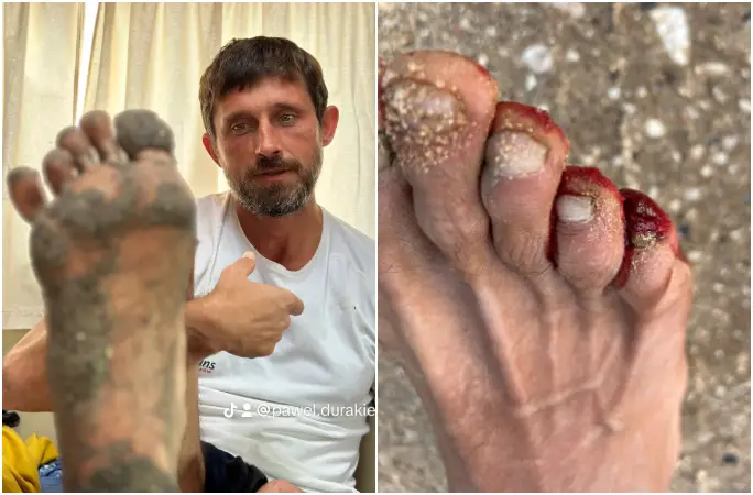 split image of Pawels injured feet