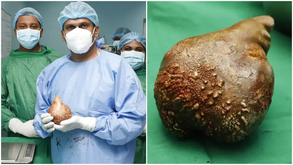 split image of largest kidney stone