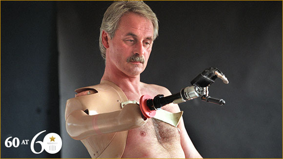 1993: First Bionic Arm