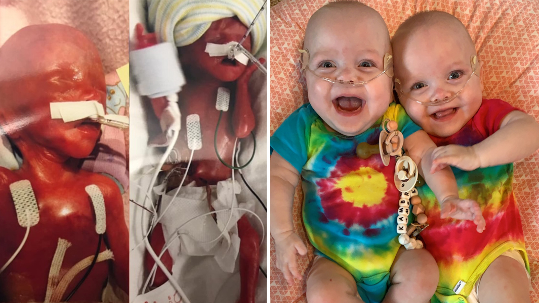 Most Premature Twins
