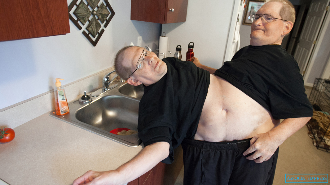 oldest-conjoined-twins