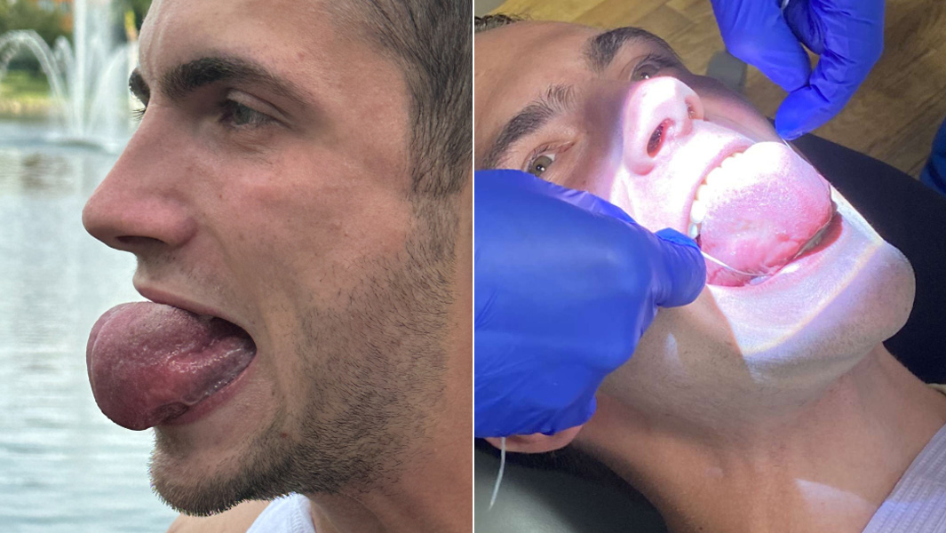 split image of Braydon inflating tongue