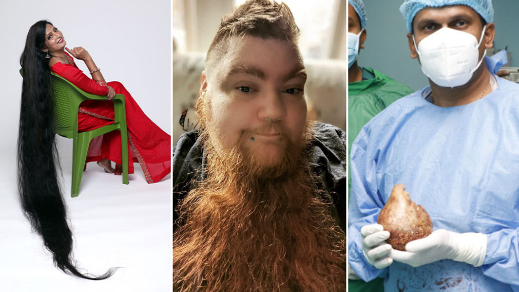 split-image-of-longest-hair-longest-beard-and-largest-kidney-stone-762622