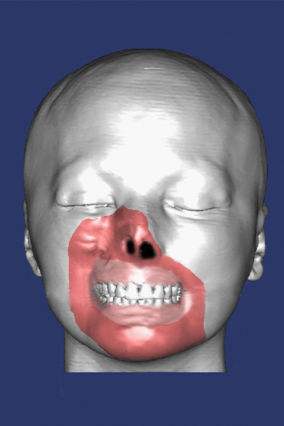 computer model of the face transplant