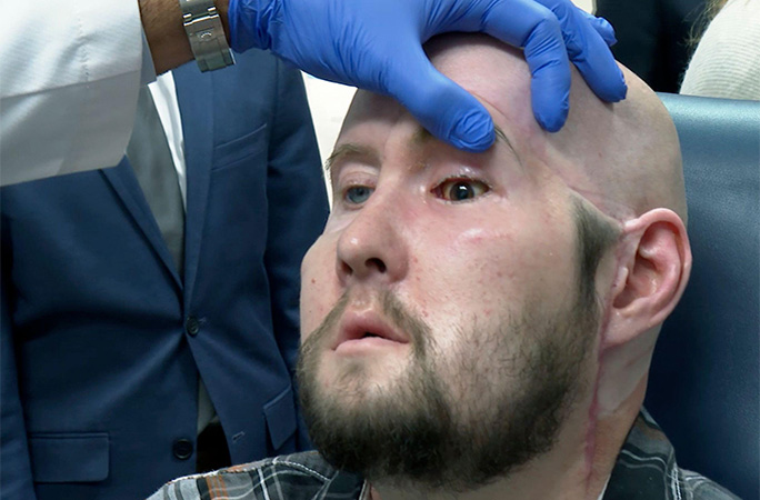 the first whole eye transplant patient