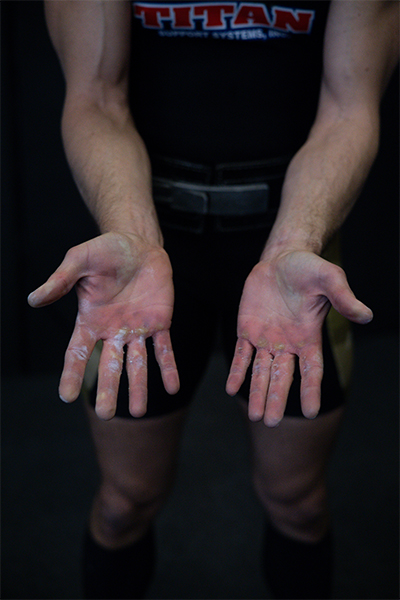 Maciej showing his injured hands