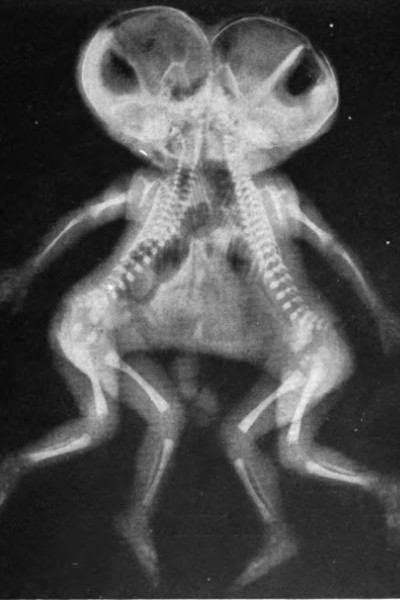 X-ray of conjoined twin skeletons