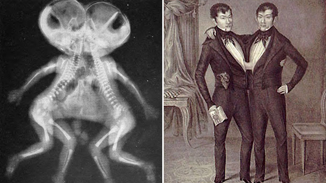 Split header image of Chang and Eng and a conjoined twin x-ray
