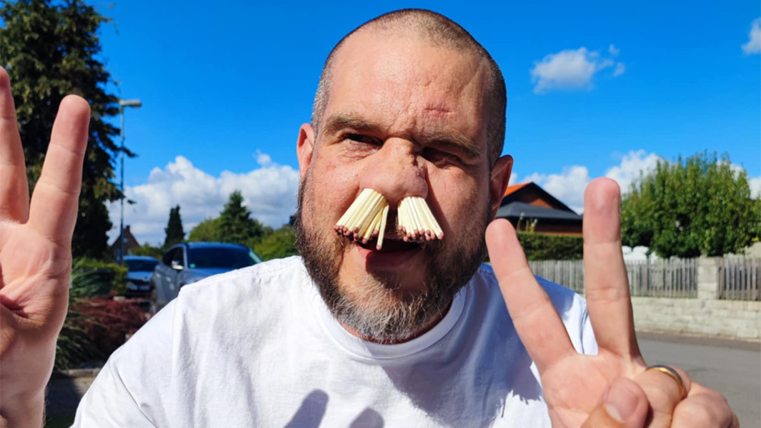Martin posing with matches up his nose