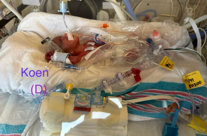Koen at birth