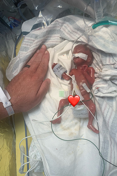 nash-keen-most-premature-baby-after-delivery-21-weeks-early-on-5-july-2024