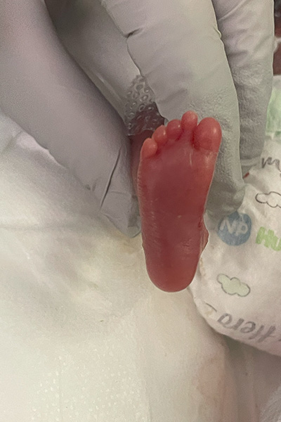 Tiny foot of most premature baby Nash Keen soon after delivery at 21 weeks old