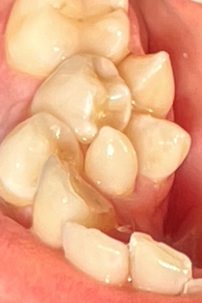 Closeup of Sylvia's teeth in her mouth