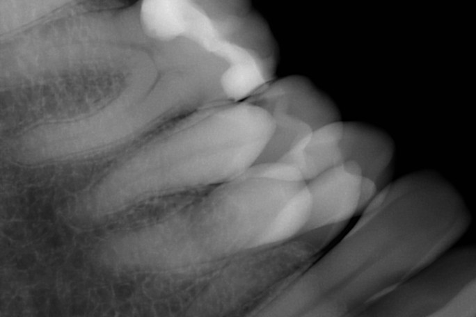 Closeup X-ray of Sylvia's teeth
