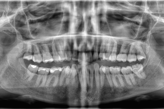 Sylvia's panorama x-ray of her mouth