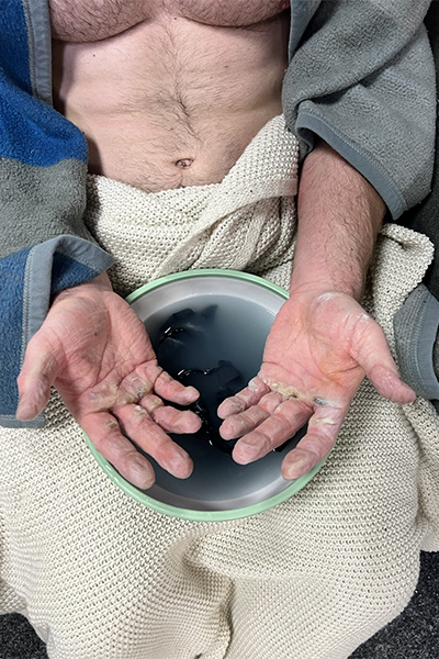 Daniel showing the blisters on his hands