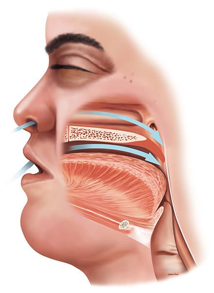 Sleep apnea illustration